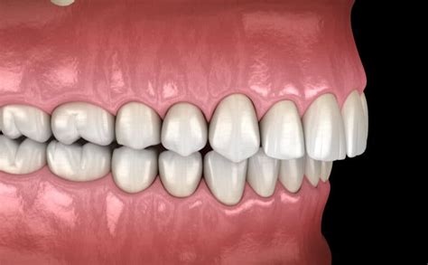 How Does My Bite Classification Impact Orthodontic Treatment