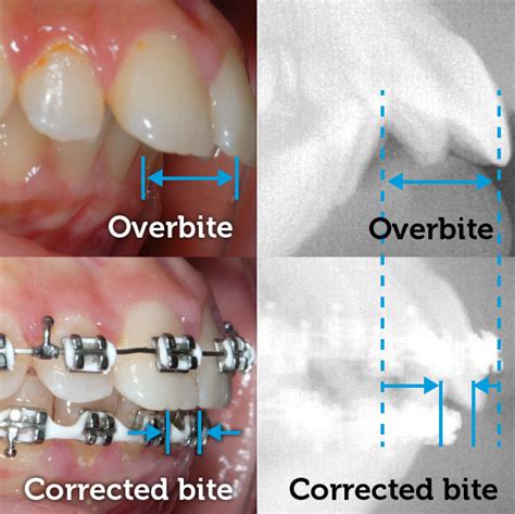 Overbite corrected with braces · South Brunswick NJ