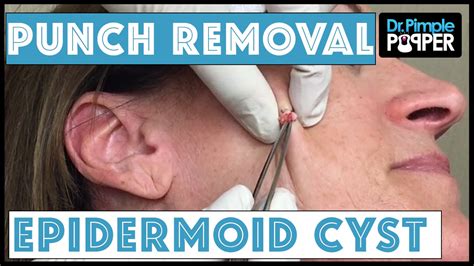 Sebaceous Cyst Face Removal