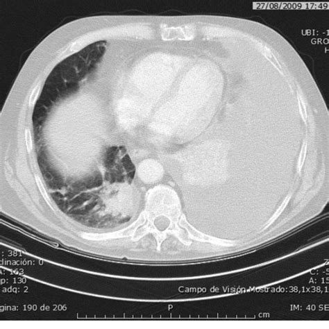 August 2009: The CT scan showed a growth of lung metastases and massive ...