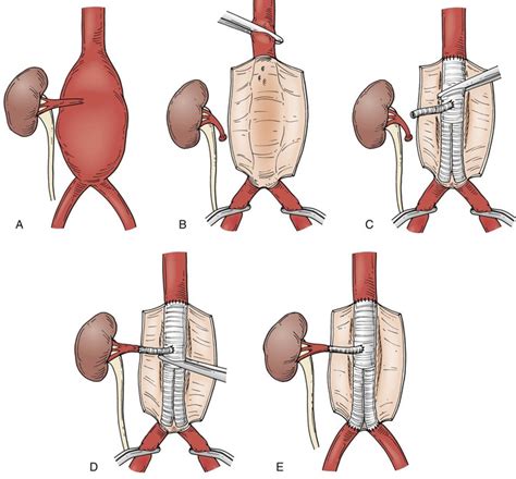 Abdominal Aortic Aneurysms | Thoracic Key