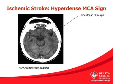 PPT - Types of Stroke PowerPoint Presentation, free download - ID:4357751