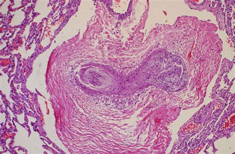 Pulmonary Hypertension Histology