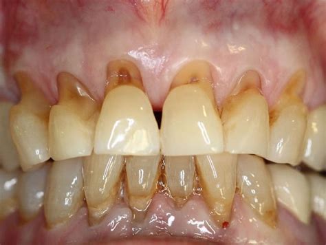 Abrasión Dental y el Cepillado Dental | Directorio Odontológico