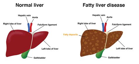 Fatty liver — symptoms, causes and treatment | healthdirect