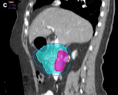 Pancreas protocol CT scan (dose painting). | Download Scientific Diagram