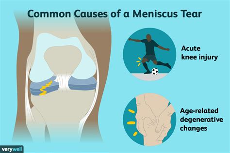 Lateral Meniscal Tear