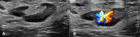 Frontiers | Ultrasound Elastography for the Evaluation of Lymph Nodes