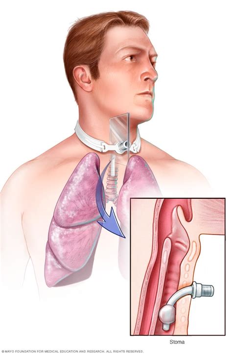 Tracheostomy - Mayo Clinic