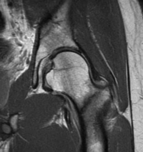 Stress Fracture of the Femoral Neck - Robert Howells