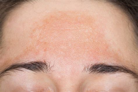 Melasma (Brown Spots or Sun Spots) | Lorna Vanderhaeghe