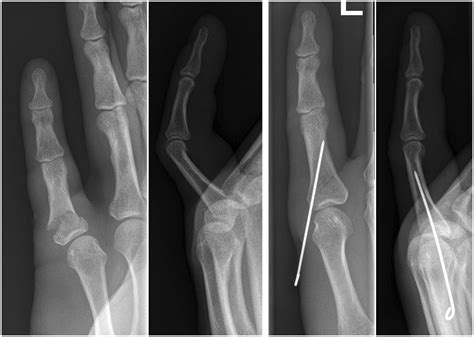 Proximal Phalanx Fracture Splint