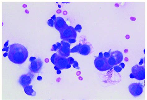 Cytological examination of the pleural fluid showing clusters of ...