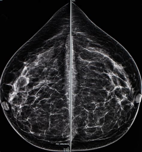 Mammogram radio imaging for breast cancer diagnosis - ODC