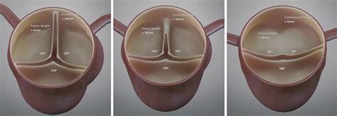 Videographic conceptual dynamic representation of bicuspid aortic valve ...