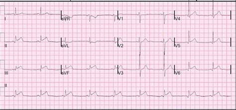 Dr. Smith's ECG Blog: Inferior STEMI: can we predict the infarct ...