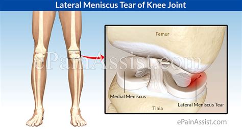 Lateral Meniscus Tear of Knee Joint|Types|Treatment-Conservative ...