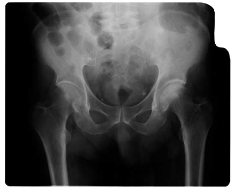 X-rays Alone Miss Many Cases of Hip Osteoarthritis : Sonos Imaging