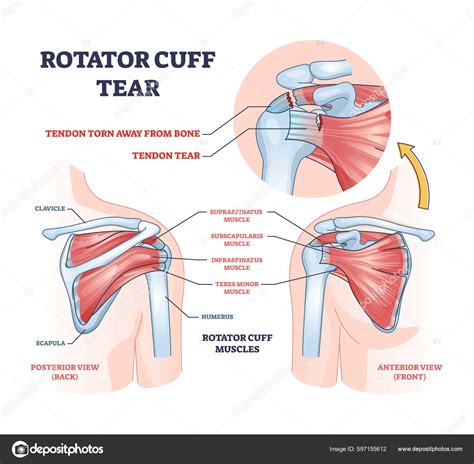 Awesome Disillusion expiration rotator cuff labeled semester surprise ...