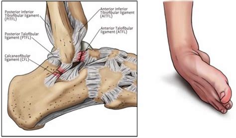 Sprained ankle symptoms, sprained ankle treatment and recovery time