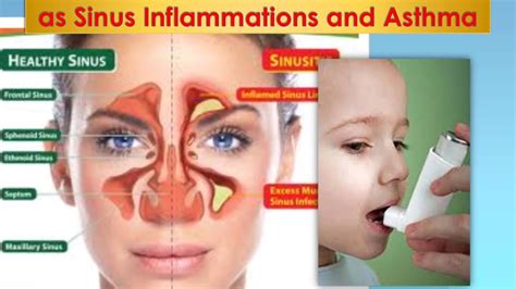 Nasal Polyps Anatomy