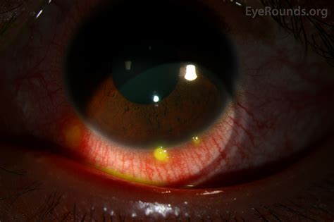 Atlas Entry - Phlyctenular Conjunctivitis