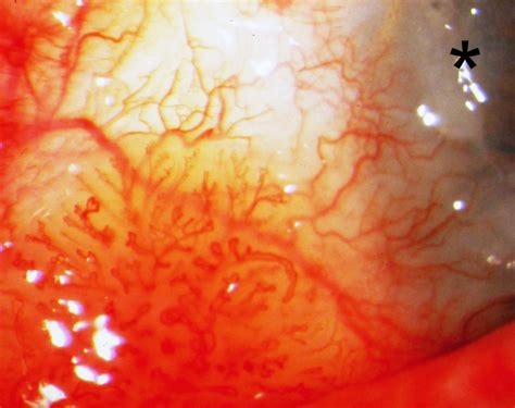 Conjunctival Squamous Cell Carcinoma