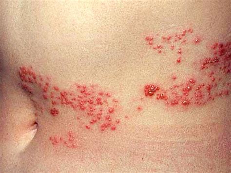 Is it shingles? 7 myths about painful illness (graphic images) - CBS News