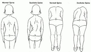 Functional scoliosis