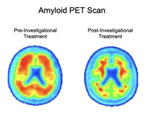 Participate in the Alzheimer's Disease Clinical Trial | The AHEAD Study