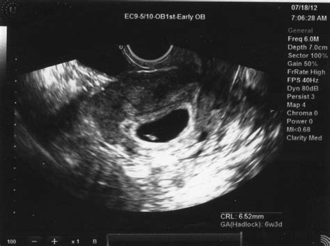 These Things I'd Never Say: 6 week ultrasound