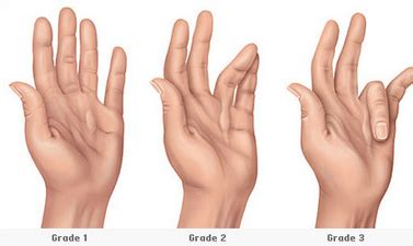 What Causes Lump to Appear in Your Palm? | Med-Health.net