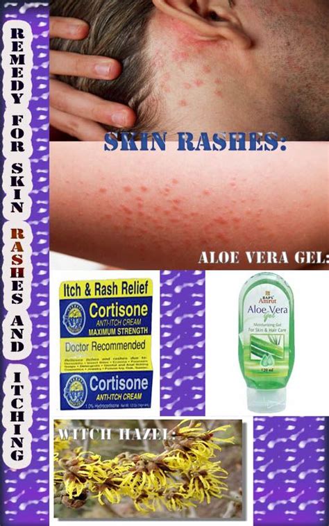 Natural Remedies to Easily Recover From Skin Rashes And Itching ...