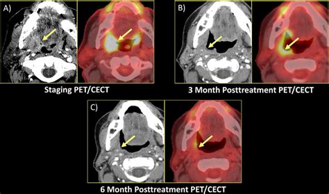 Tonsil Cancer Staging