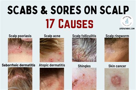 Scabs and Sores on Scalp: 17 Causes, Pictures and Treatment