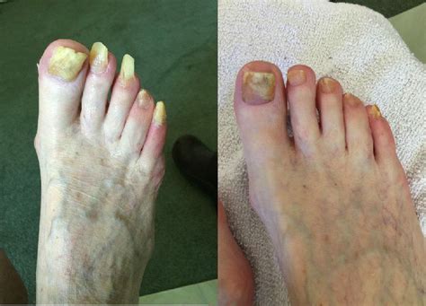 Before & After Gallery | Advanced Foot Care