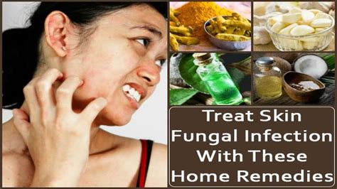 Effective Home Remedies To Treat Skin Fungal Infection - Boldsky.com