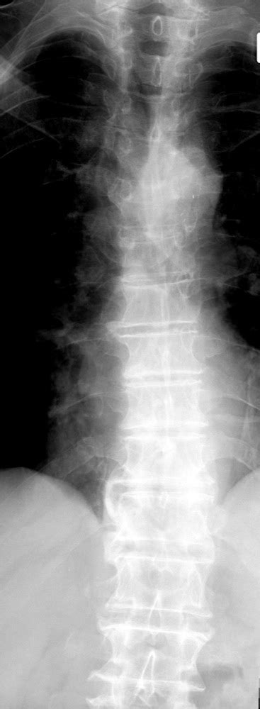 Spondylosis Xray