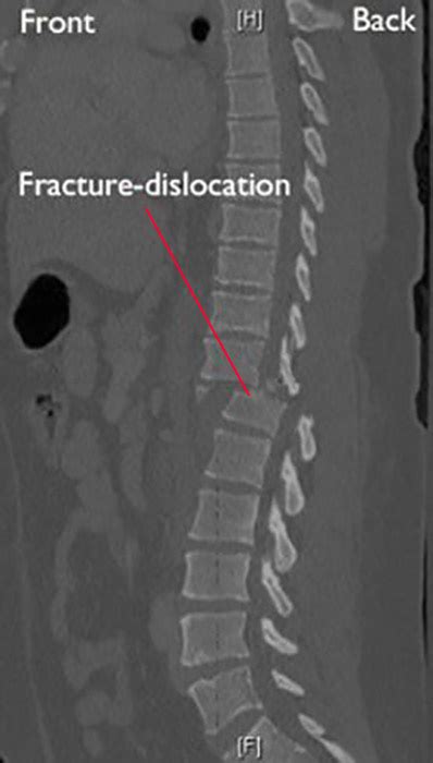 Fractures of the Thoracic and Lumbar Spine - OrthoInfo - AAOS