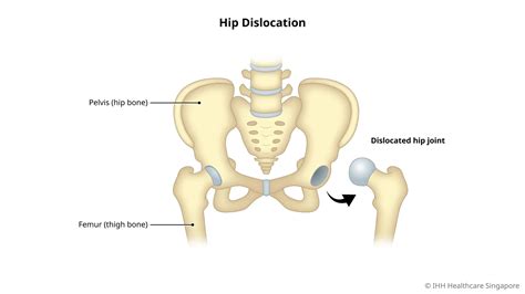 Dislocated Hip (Posterior or Anterior) - Symptoms & Causes | Parkway ...