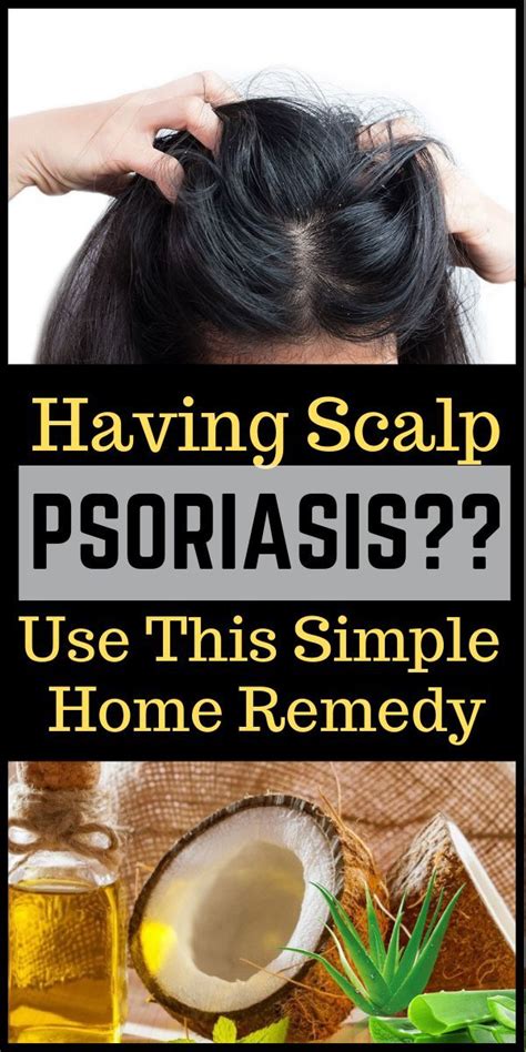 Home Remedies To Treat Scalp Psoriasis - thepopularrecipe3