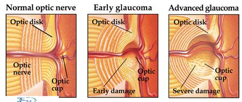 Glaucoma : Symptoms, Types, Causes & Treatment » How To Relief