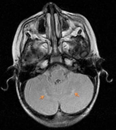 metachromatic leukodystrophy | pacs