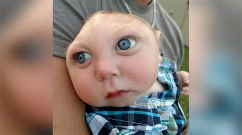 Baby born without part of skull defies odds, celebrates 1st birthday ...