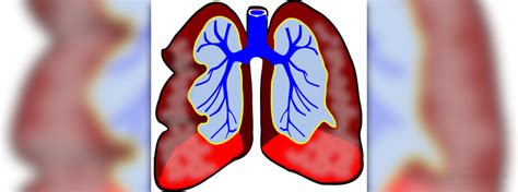 Lung disease types | Respiratory tract disorders and diseases articles ...