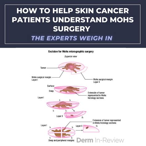 How to Help Skin Cancer Patients Understand Mohs Surgery | The Experts ...