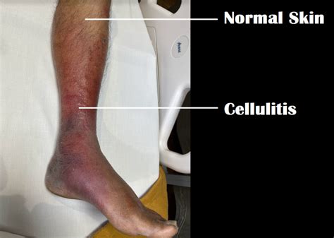 Cellulitis Of The Legs - Causes, Symptoms, And Treatment