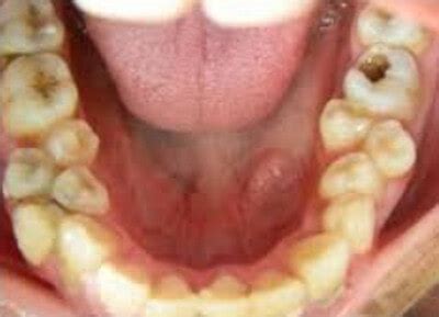 Supernumerary Teeth (Hyperdontia) - Numbering Chart and Removal - (2018 ...