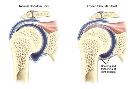 What Causes Frozen Shoulder, and the Most Effective Treatment