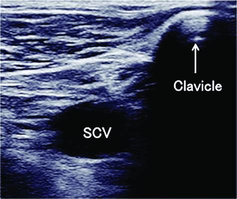 The ultrasound short axis view at the closest point where the ...